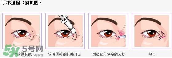 哪些人需要開眼角？需要開眼角的眼睛圖片