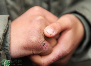 三月份還長凍瘡嗎？三月份凍瘡沒好怎么辦？