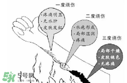 燙傷起泡要挑破嗎？燙傷起泡怎么處理？