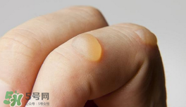 燙傷起泡要挑破嗎？燙傷起泡怎么處理？