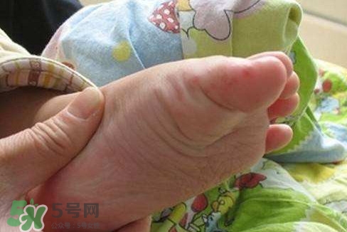 手足口病如何預(yù)防？手足口病怎樣預(yù)防