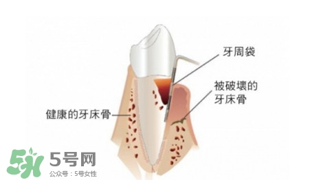 牙周炎怎么治療？牙周炎怎么治好