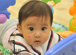 嬰兒被蚊子咬了如何去紅點(diǎn)？被蚊子咬后紅點(diǎn)如何去除？
