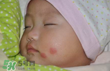 嬰兒被蚊子咬了如何去紅點(diǎn)？被蚊子咬后紅點(diǎn)如何去除？