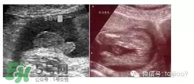 B超單數(shù)據(jù)怎么看男女？B超單看男女準(zhǔn)嗎？
