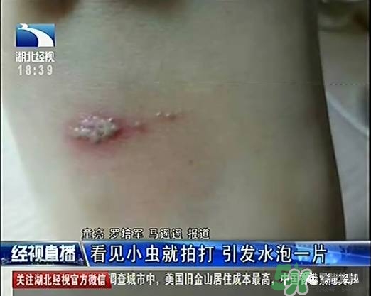 隱翅蟲(chóng)有毒嗎？隱翅蟲(chóng)會(huì)毀容嗎？