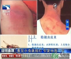 隱翅蟲(chóng)有毒嗎？隱翅蟲(chóng)會(huì)毀容嗎？