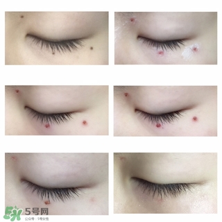 藥水點痣和激光點痣哪個好？各有什么優(yōu)缺點