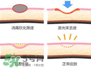 藥水點痣和激光點痣哪個好？各有什么優(yōu)缺點