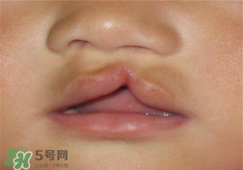 兔唇能檢查出來(lái)嗎？兔唇能完全修復(fù)嗎？