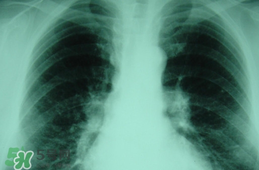 塵肺病能換肺治愈嗎？塵肺病不能吃什么