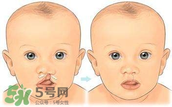 兔唇能檢查出來(lái)嗎？兔唇能完全修復(fù)嗎？