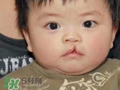 兔唇可以治嗎？兔唇修補術