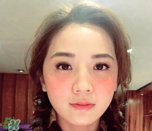 夏天可以點(diǎn)痣嗎？夏天點(diǎn)痣后要注意什么？
