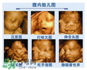 四維彩超有必要做嗎？四維彩超檢查不出什么？