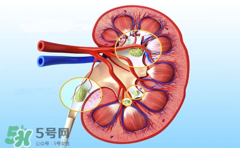 腎結(jié)石有什么癥狀？腎結(jié)石原因
