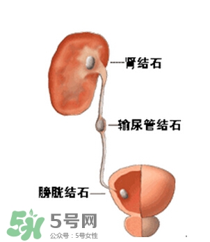 腎結(jié)石有什么癥狀？腎結(jié)石原因