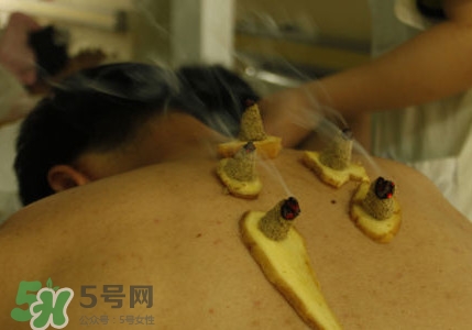 三伏灸有用嗎？2017年三伏艾灸時間