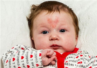 寶寶胎記是怎么來的？寶寶胎記是怎么形成的？