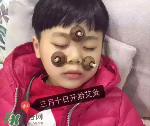 艾灸貼可以治咳嗽嗎？艾灸貼可以治退燒嗎？