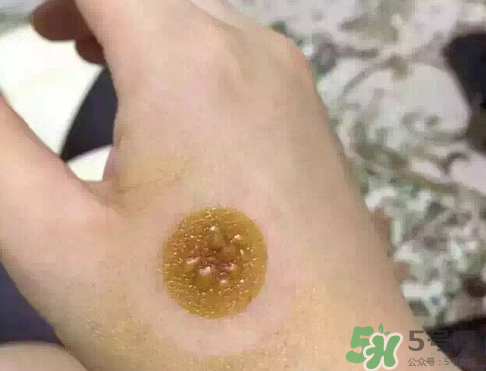 艾灸貼后有水泡怎么辦？貼艾灸貼應(yīng)注意些什么？