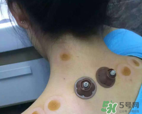 艾灸貼后有水泡怎么辦？貼艾灸貼應(yīng)注意些什么？