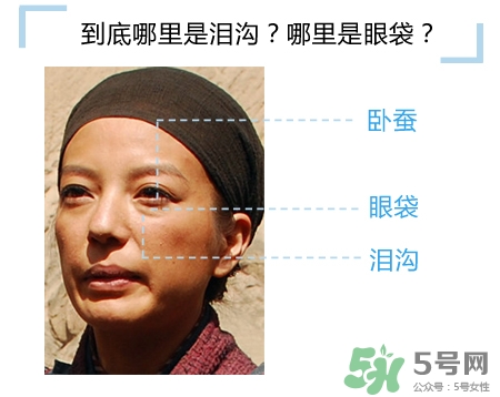 玻尿酸填充淚溝多久恢復(fù)自然？玻尿酸填充淚溝的危害