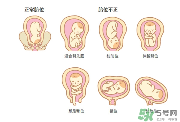 胎位不正如何矯正？胎位不正一定要剖腹產(chǎn)嗎？