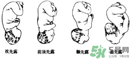 胎位不正能順產(chǎn)嗎？胎位不正怎么辦？