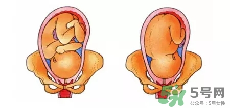 胎位不正能順產(chǎn)嗎？胎位不正怎么辦？