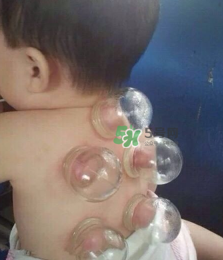 拔火罐后顏色多久消失？拔火罐印子多久能消除？