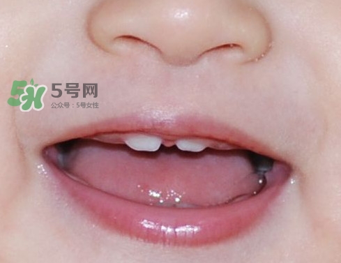 牙齒縫隙大怎么辦？牙縫大帶牙套有用嗎