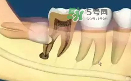 智齒是每個(gè)人都會(huì)長(zhǎng)嗎？拔智齒能瘦臉嗎？