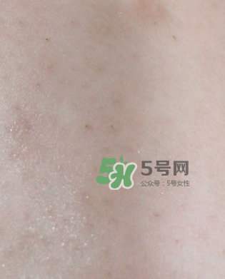 Dermatix舒痕疤痕膏有效嗎？Dermatix舒痕疤痕膏怎么用？