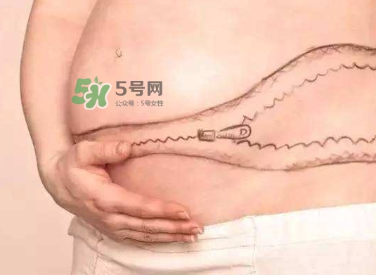 剖腹產(chǎn)疤痕怎么去除？剖腹產(chǎn)疤痕能去掉嗎？