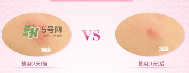 3m痘痘貼怎么用？3m痘痘貼貼多久？