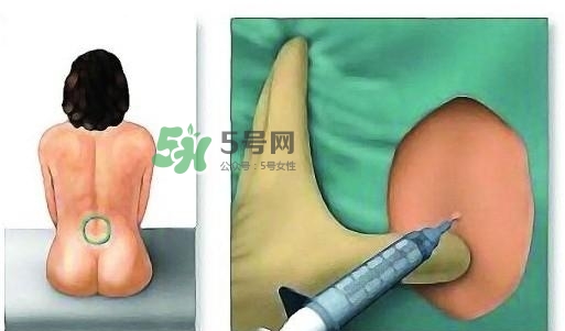 無痛分娩為什么不提倡？無痛分娩有后遺癥嗎？