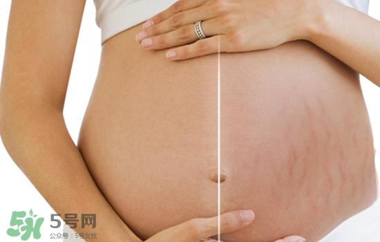 妊娠紋在左邊生男或女？怎么從妊娠紋看男女？