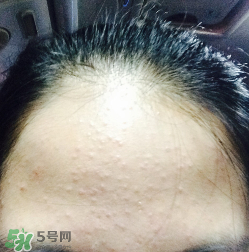 長痘長閉口怎么辦？長痘長閉口是什么原因？
