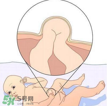 臍疝是什么？臍疝對(duì)寶寶有什么影響？