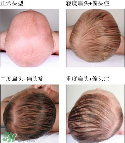 寶寶頭型是睡出來(lái)的嗎？寶寶頭型矯正最佳時(shí)間