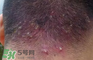 痤瘡和毛囊炎一樣嗎？痤瘡與毛囊炎區(qū)別
