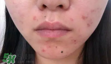 痤瘡和毛囊炎一樣嗎？痤瘡與毛囊炎區(qū)別