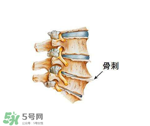 骨刺是怎么形成的？骨刺怎么治療？