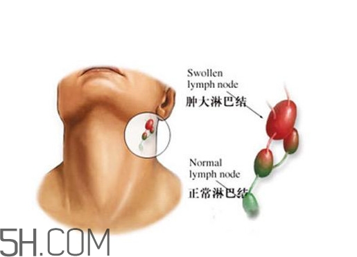 淋巴癌能活多久？淋巴癌癥狀有哪些