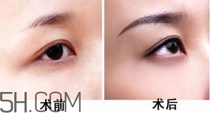 切眉手術(shù)后老得快嗎？切眉能保持多久？