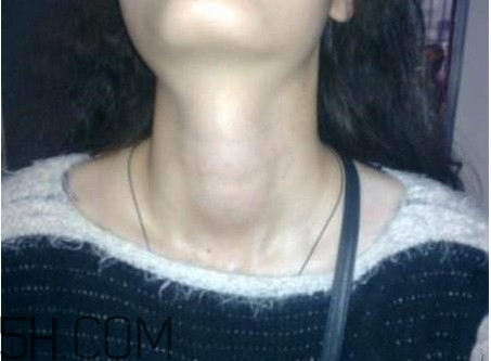 甲狀腺結(jié)節(jié)掛什么科？甲狀腺結(jié)節(jié)可以懷孕嗎