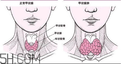 甲狀腺結(jié)節(jié)與甲狀腺腫瘤的區(qū)別有哪些？甲狀腺結(jié)節(jié)可以艾灸嗎