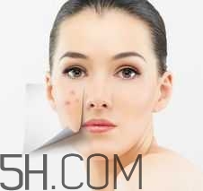 濕熱型痤瘡是什么？怎么調(diào)理濕熱型痤瘡？