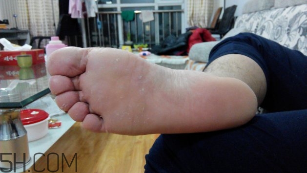 腳氣可以用酒精消毒嗎？腳氣可以用碘伏消毒嗎？